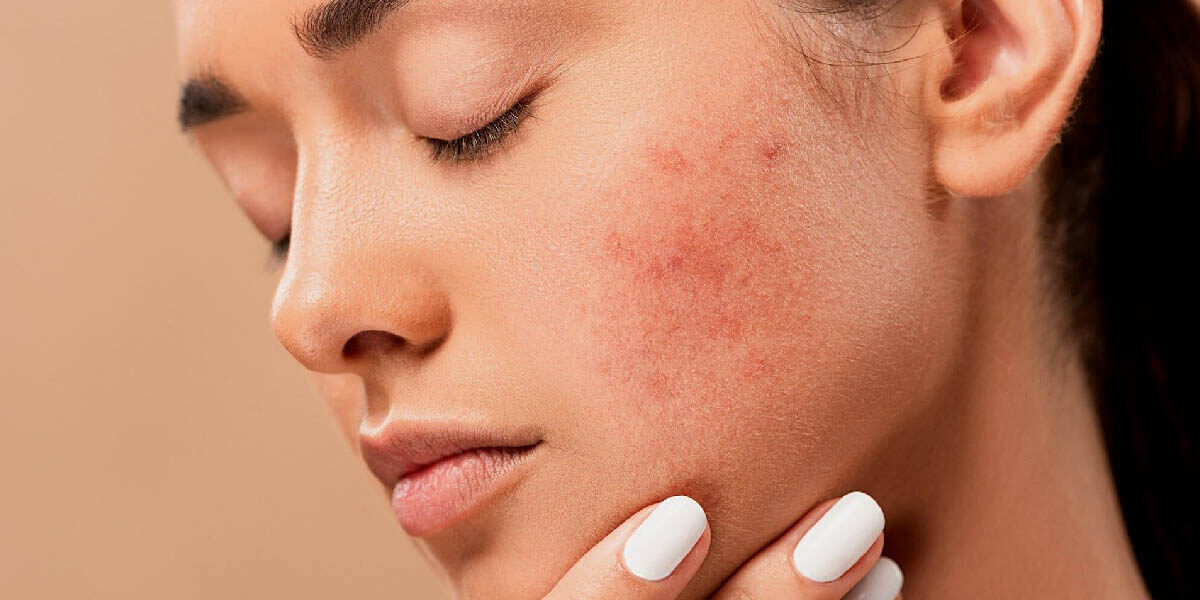 Acne versus Rosacea: Understanding both and identifying the differences